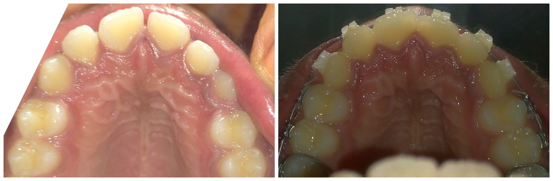 Before and after treatment