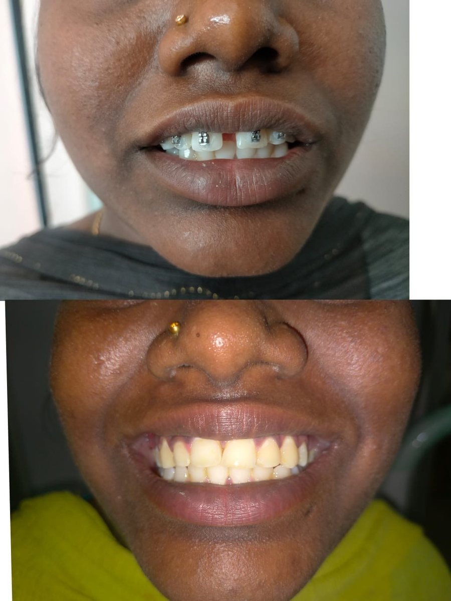 Adult Orthodontic Consultation — before and after, patient 1