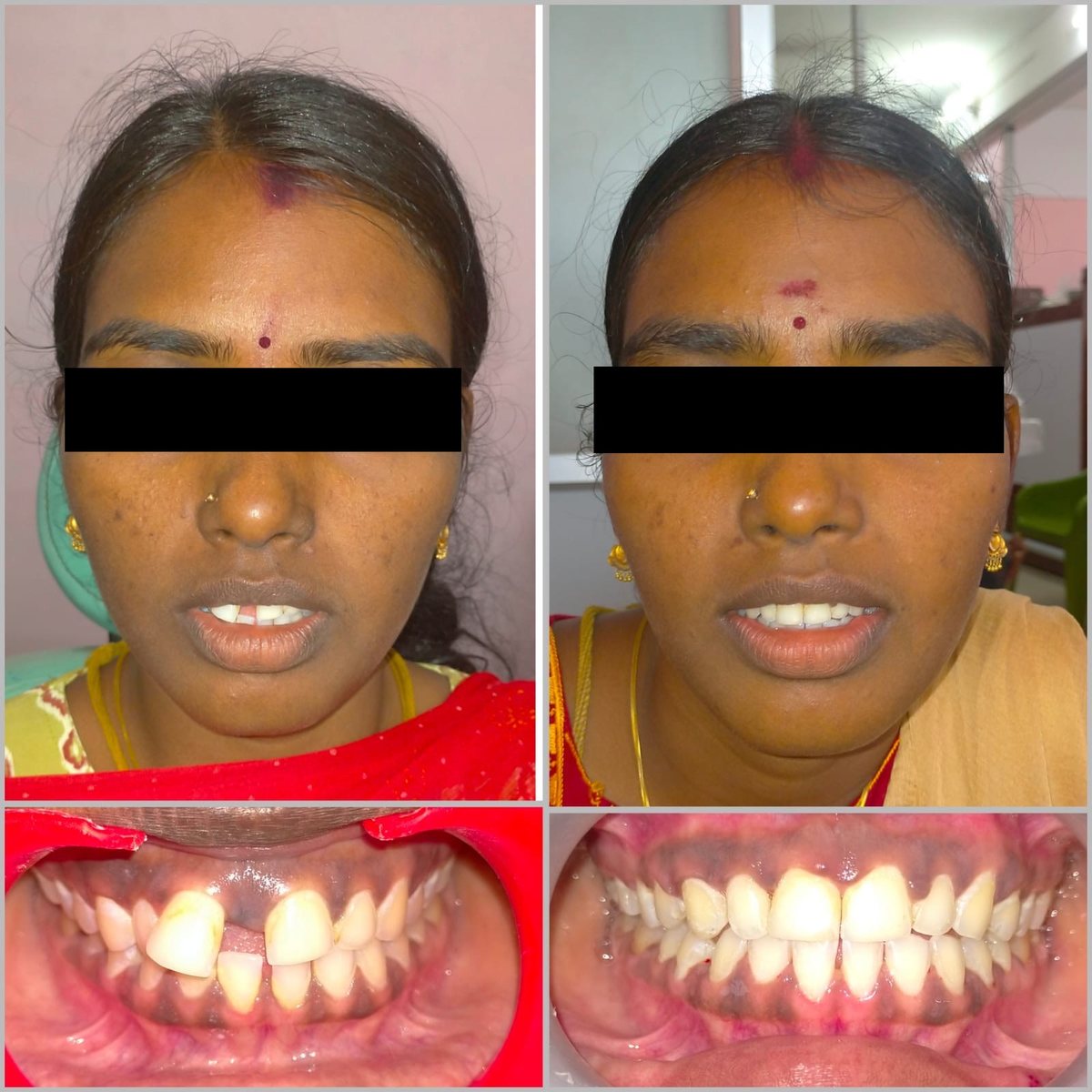 Adult Orthodontic Consultation — before and after, patient 10