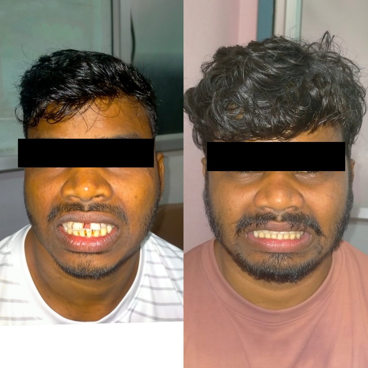 Adult Orthodontic Consultation — before and after, patient 11