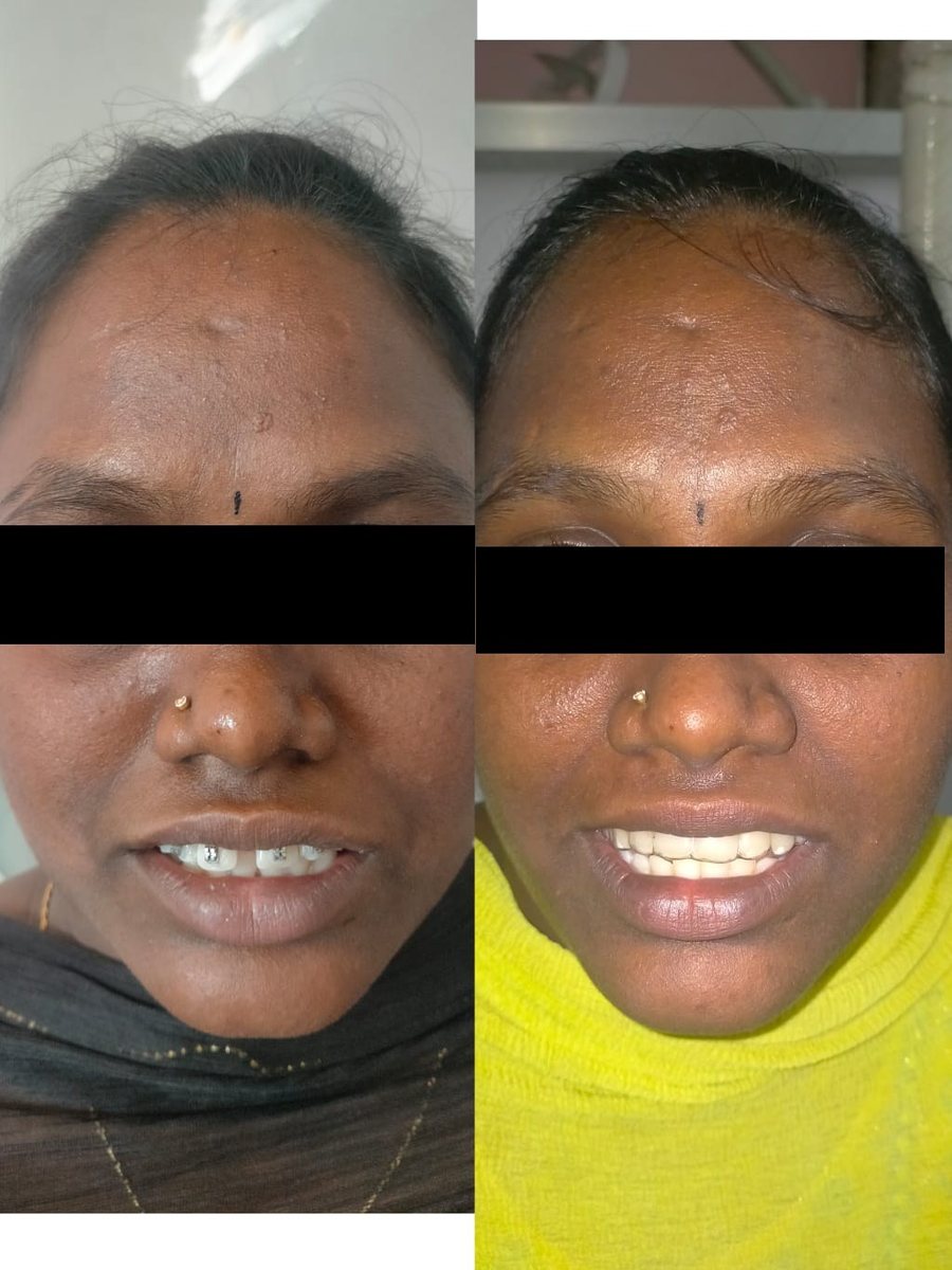 Adult Orthodontic Consultation — before and after, patient 2