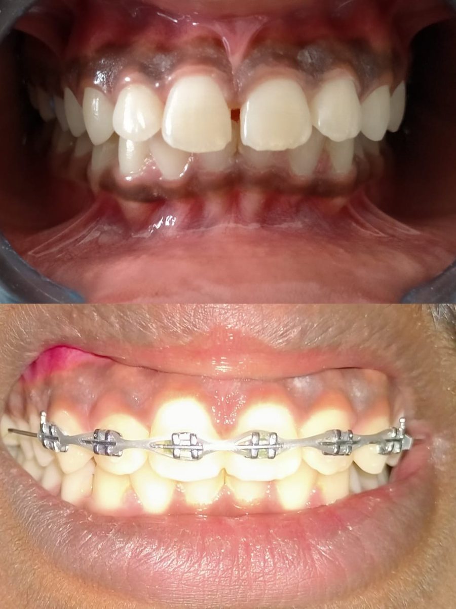 Adult Orthodontic Consultation — before and after, patient 3
