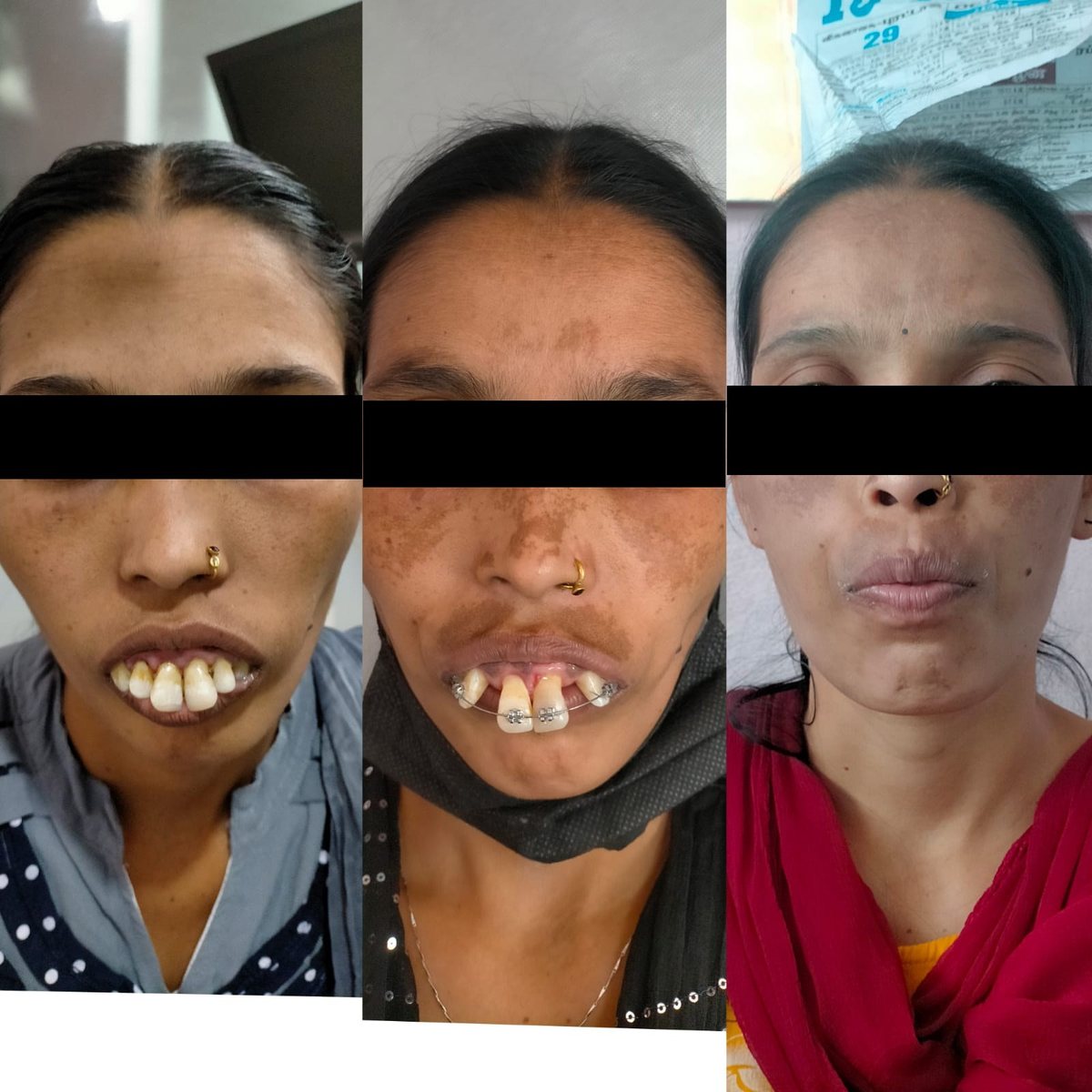 Adult Orthodontic Consultation — before and after, patient 4