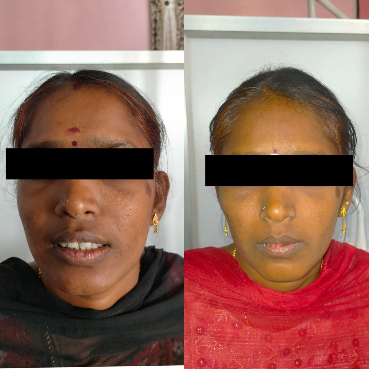 Adult Orthodontic Consultation — before and after, patient 5