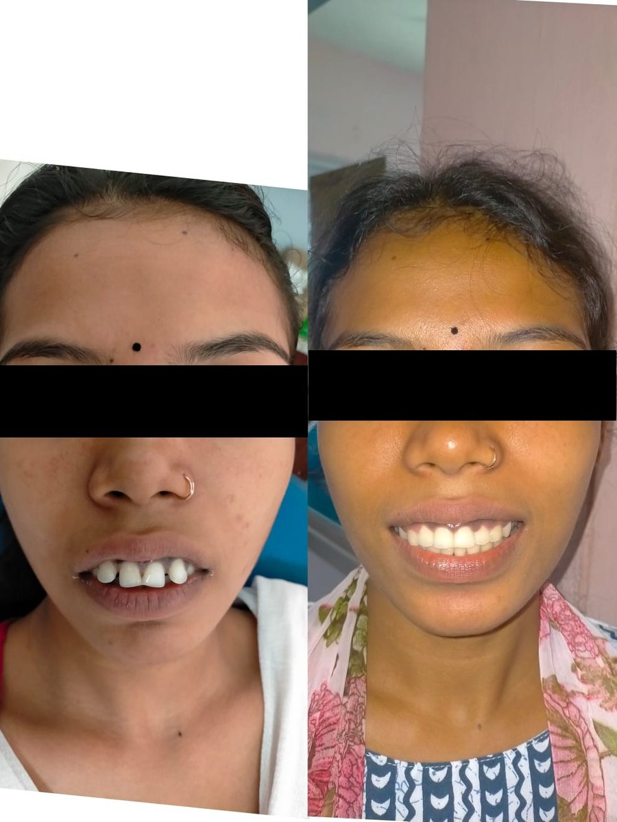 Adult Orthodontic Consultation — before and after, patient 6