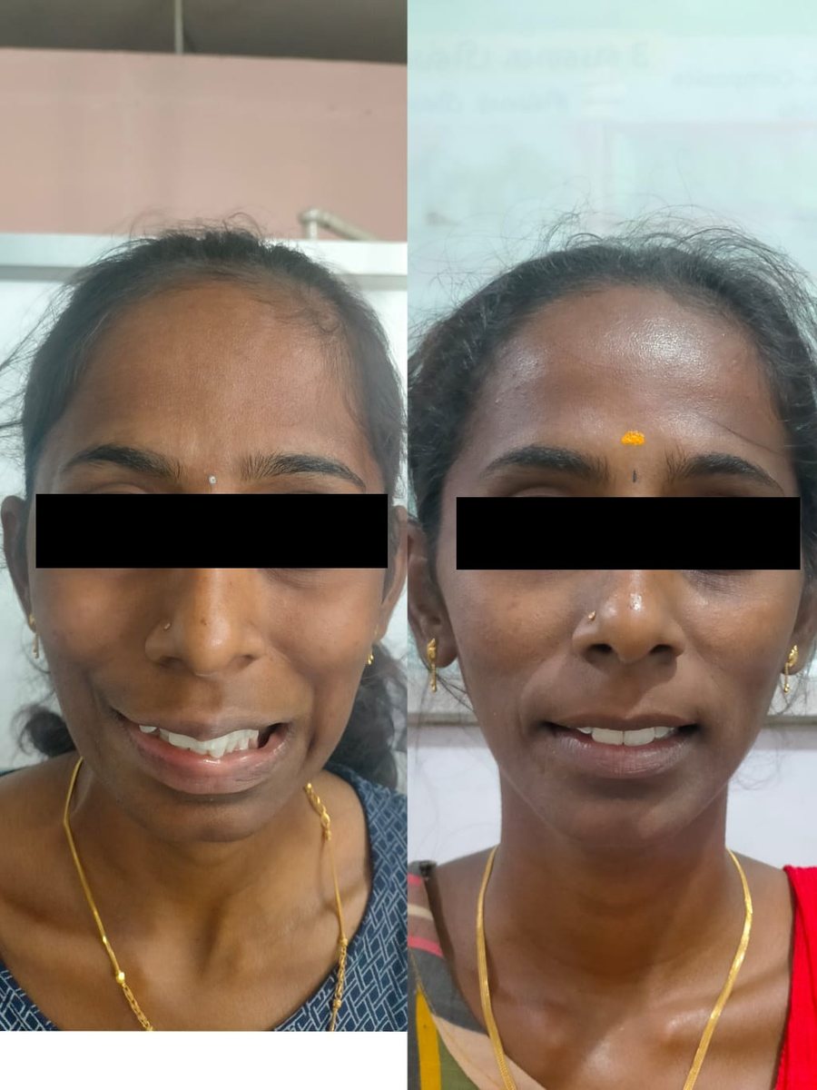 Adult Orthodontic Consultation — before and after, patient 7