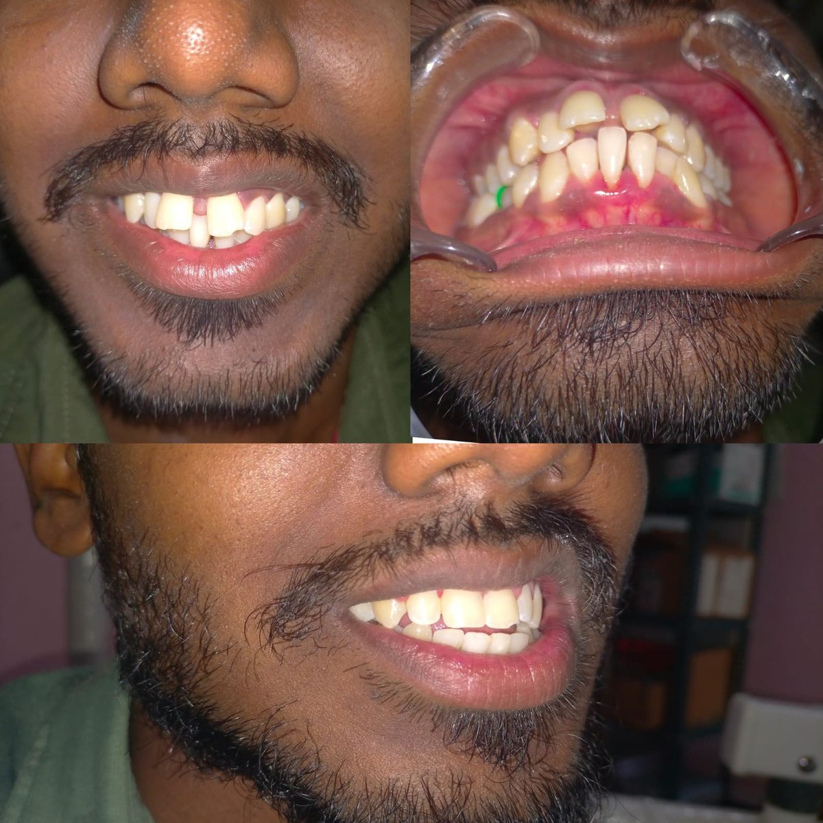 Adult Orthodontic Consultation — before and after, patient 8