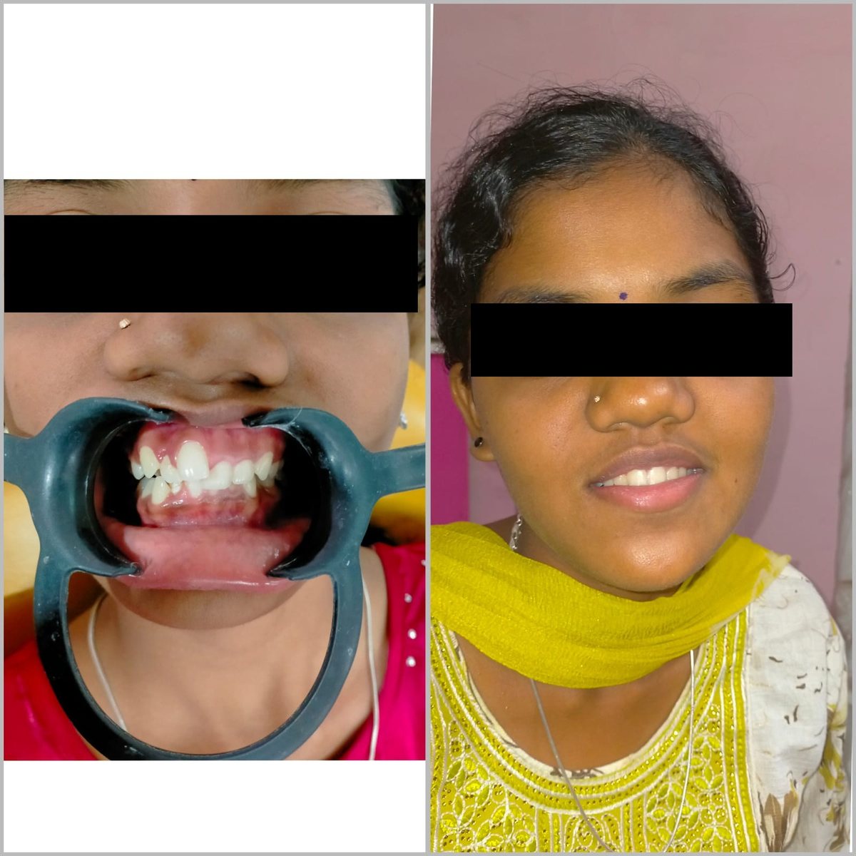 Adult Orthodontic Consultation — before and after, patient 9