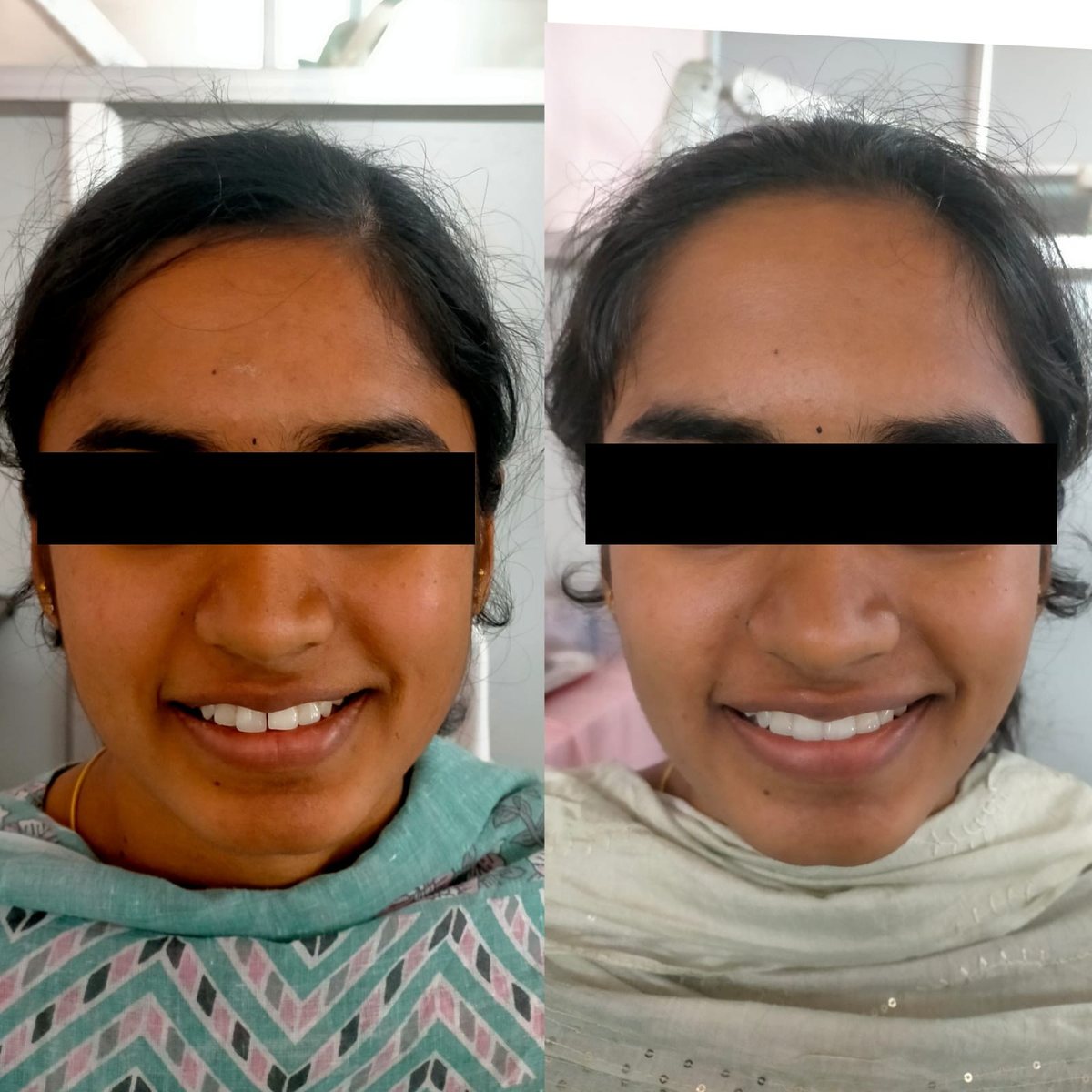 Aligner Treatment — before and after, patient 1