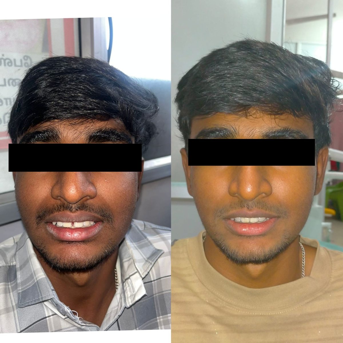 Aligner Treatment — before and after, patient 2