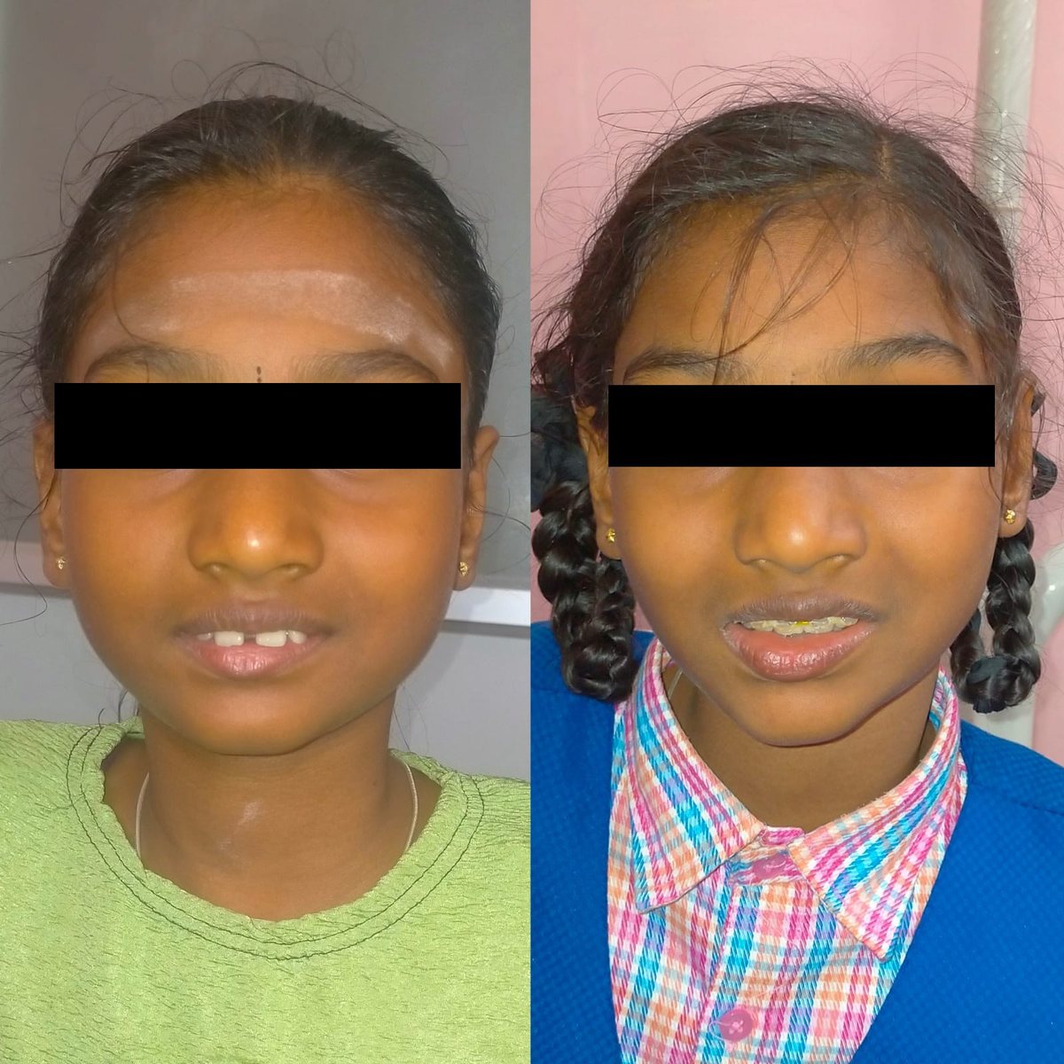 Child Orthodontic Consultation — before and after, patient 1