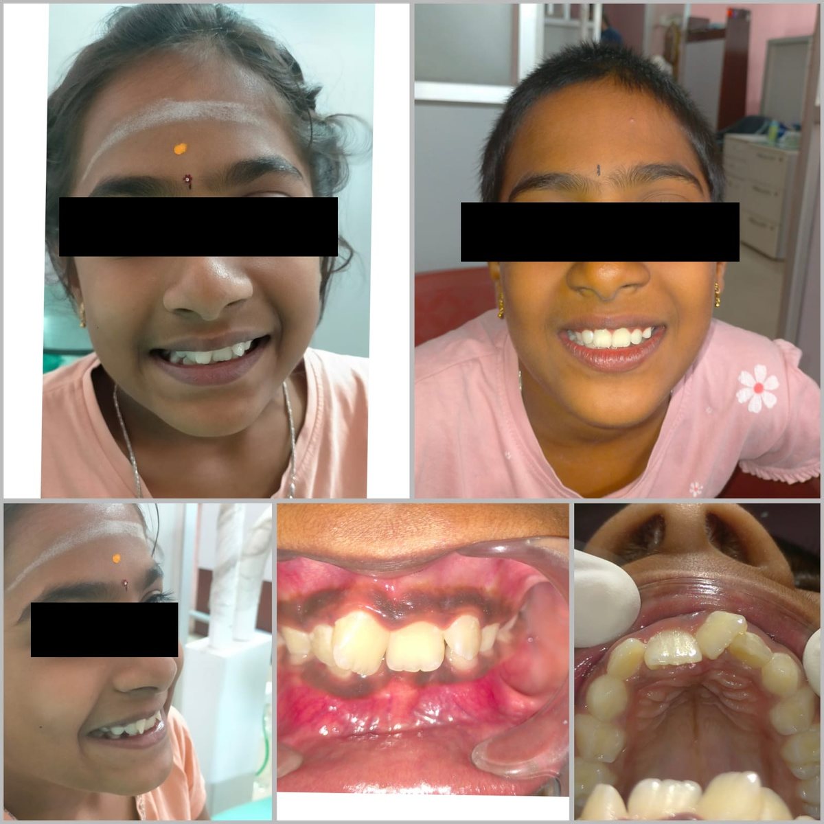 Child Orthodontic Consultation — before and after, patient 2