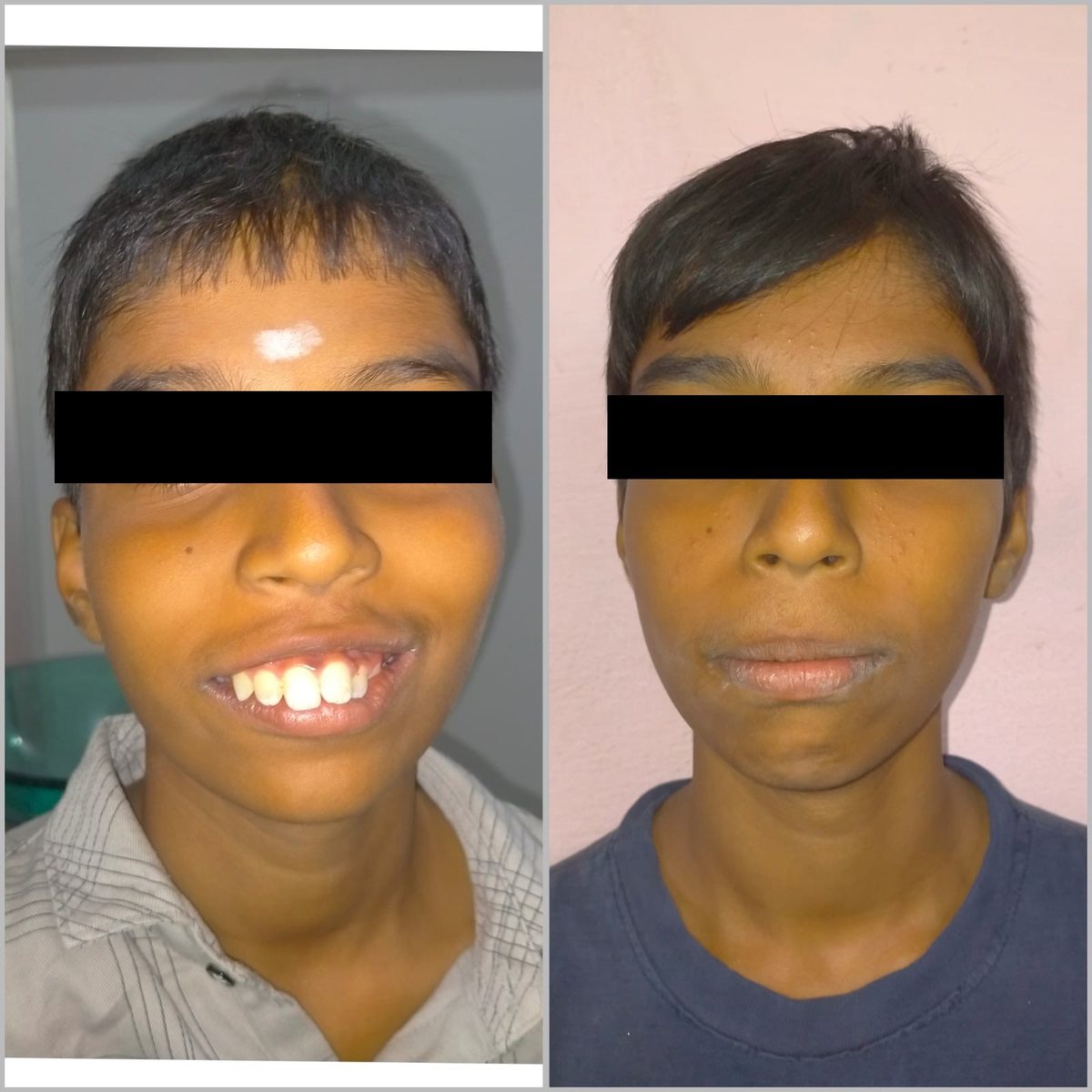 Child Orthodontic Consultation — before and after, patient 3