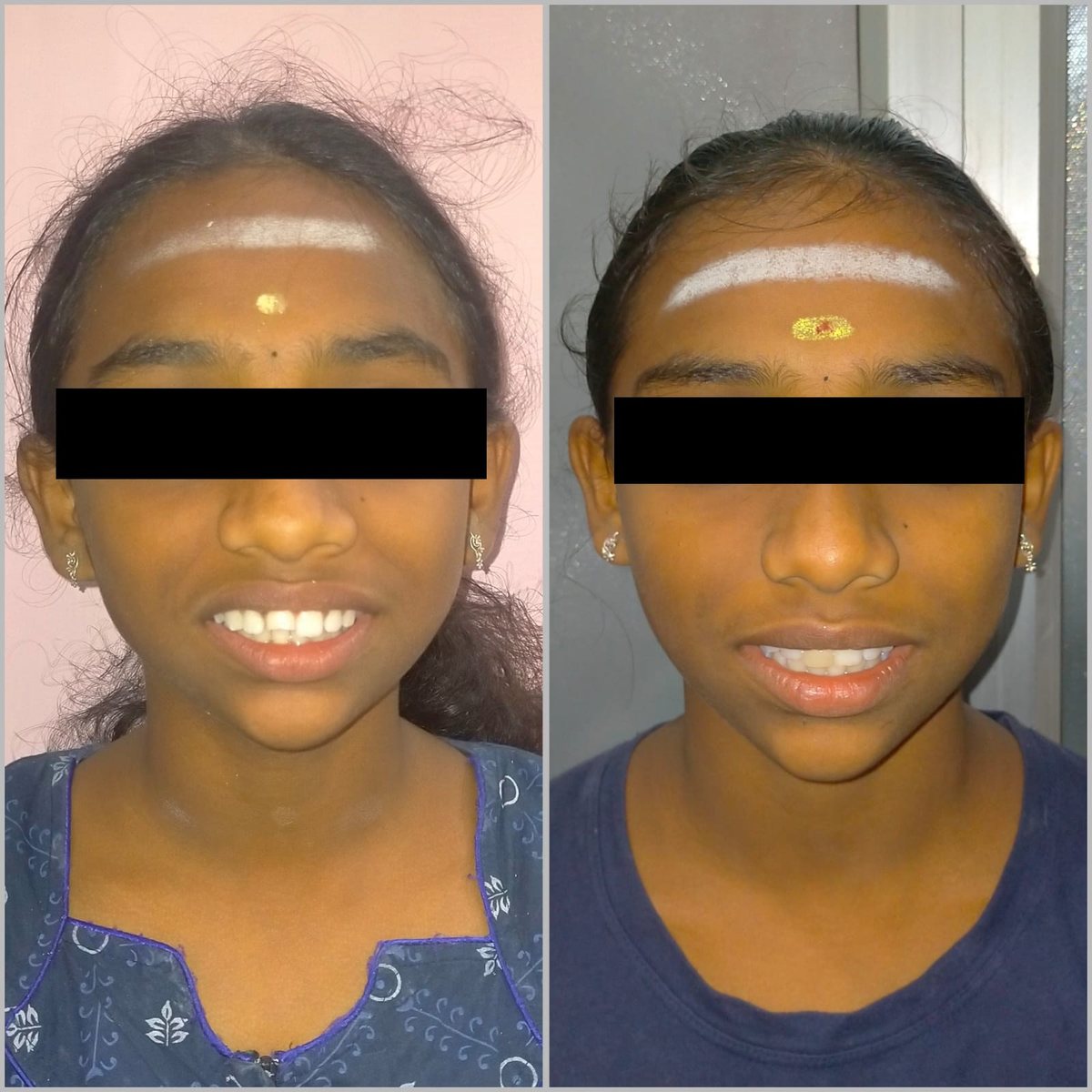 Child Orthodontic Consultation — before and after, patient 4