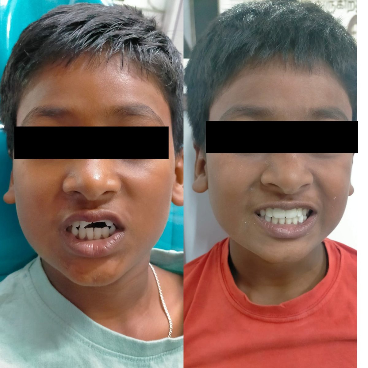 Crowns with Post or Core — before and after, patient 1