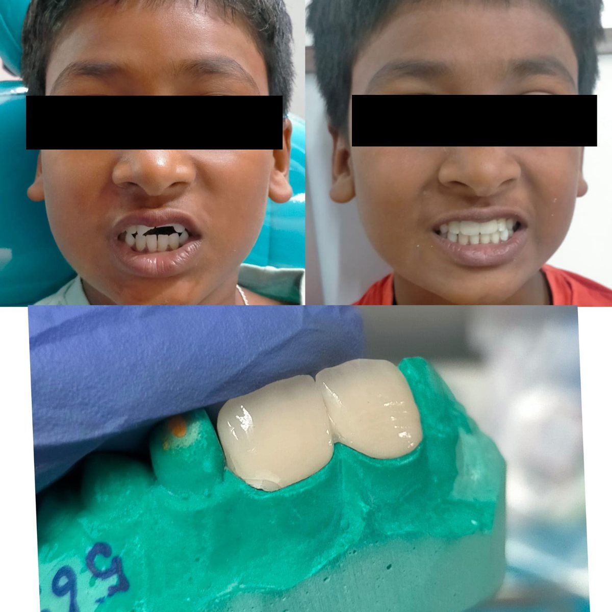 Crowns with Post or Core — before and after, patient 2