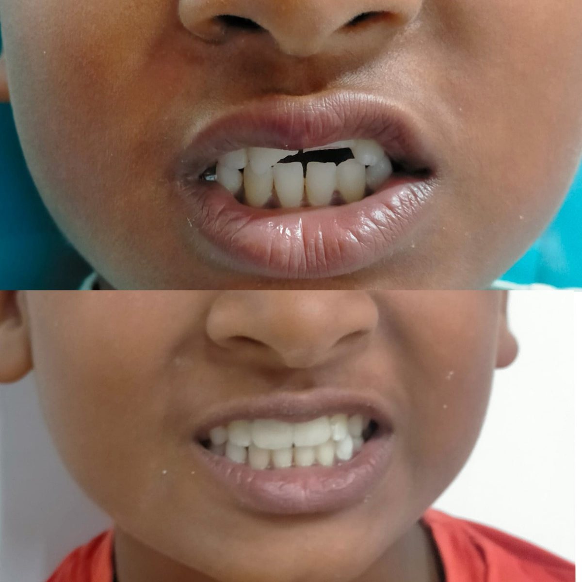 Crowns with Post or Core — before and after, patient 3