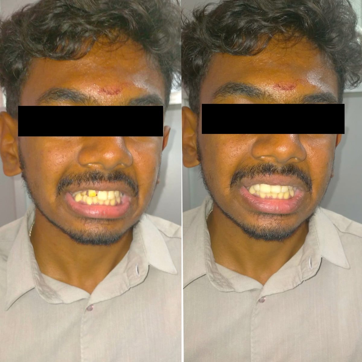 Crowns with Post or Core — before and after, patient 4