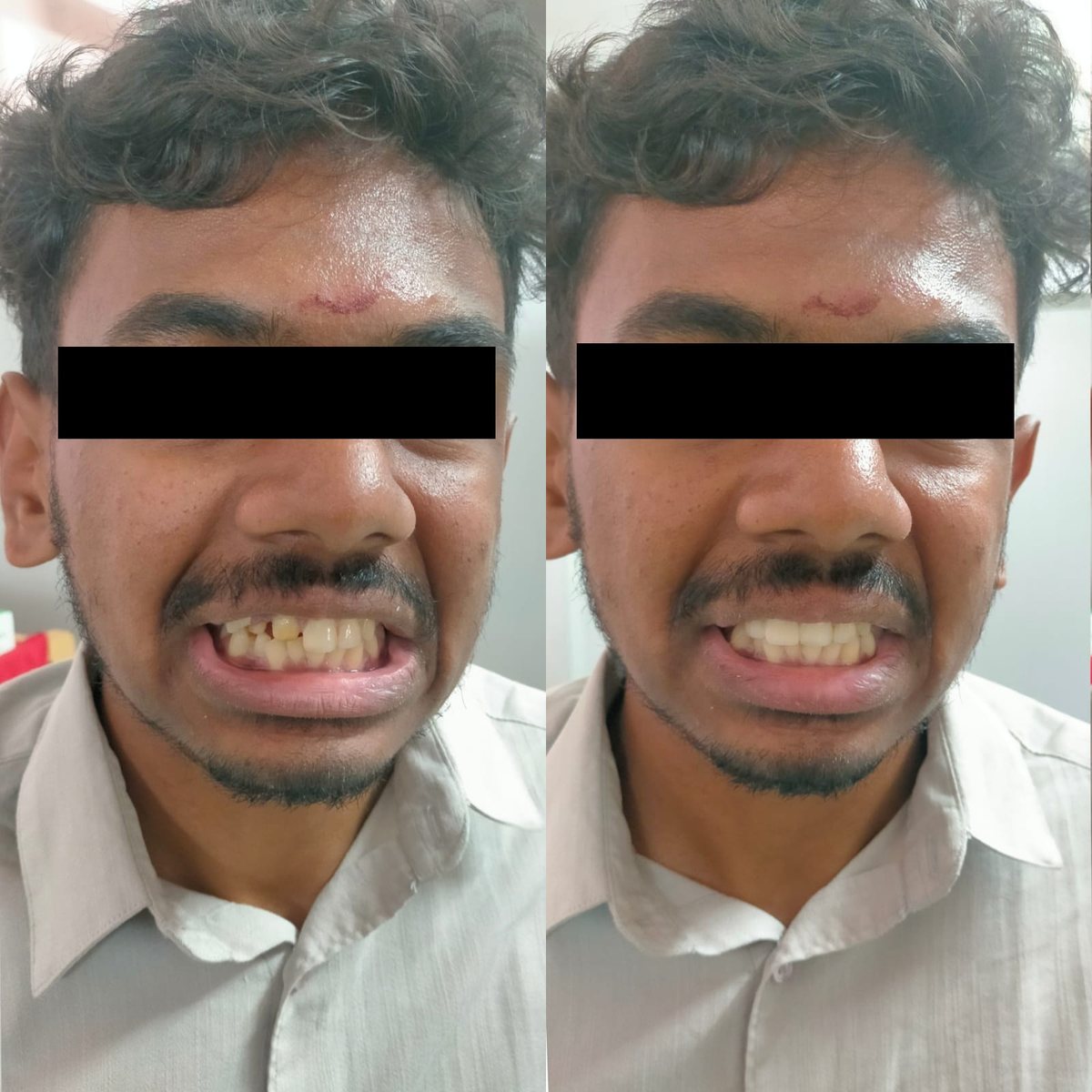 Crowns with Post or Core — before and after, patient 5