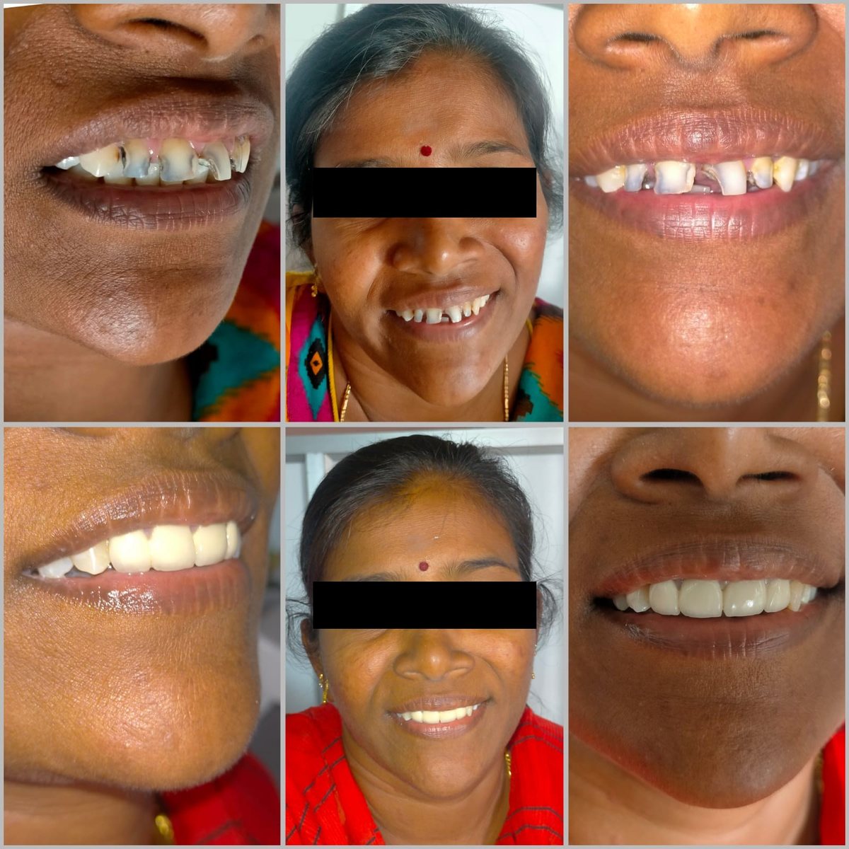 Crowns with Post or Core — before and after, patient 6