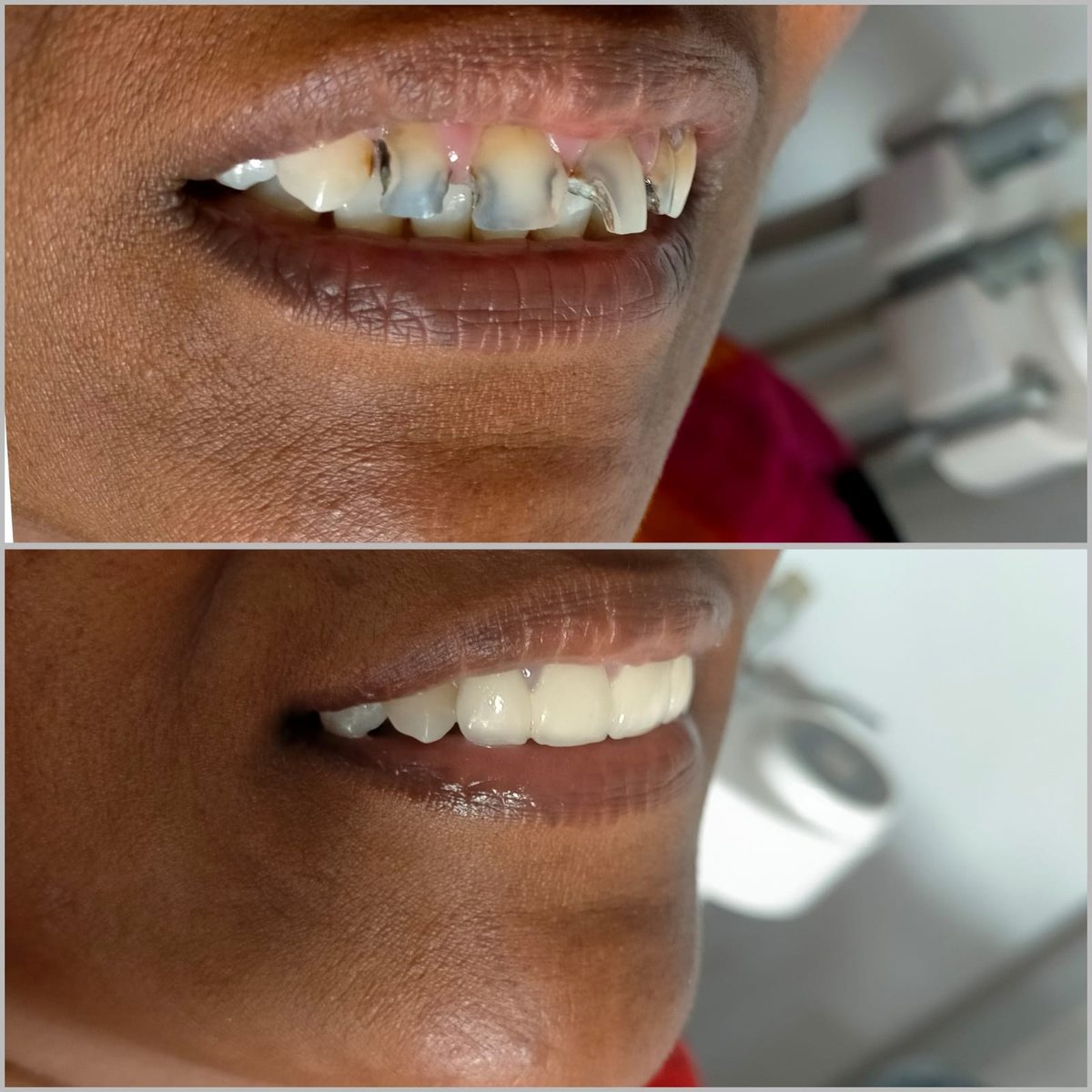 Crowns with Post or Core — before and after, patient 7