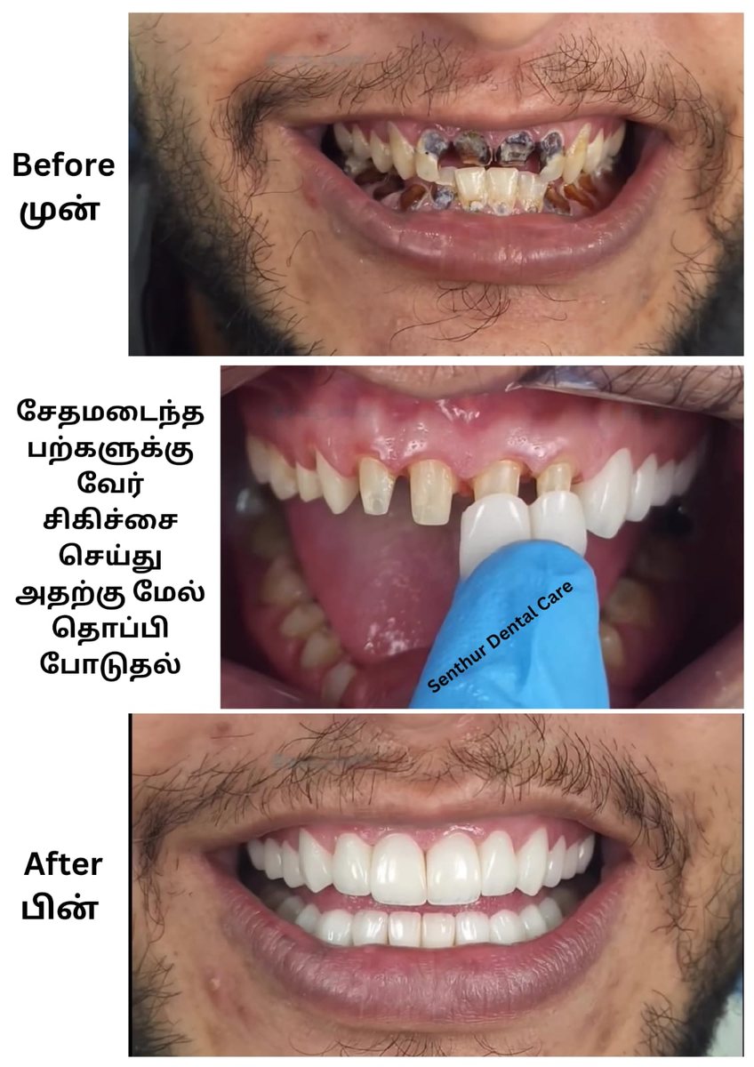 Dental Bridgework Treatment — before and after, patient 1
