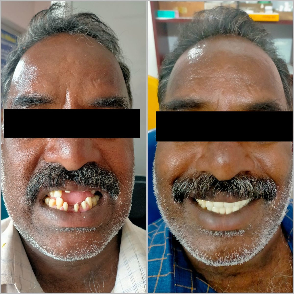 Dental Bridgework Treatment — before and after, patient 10