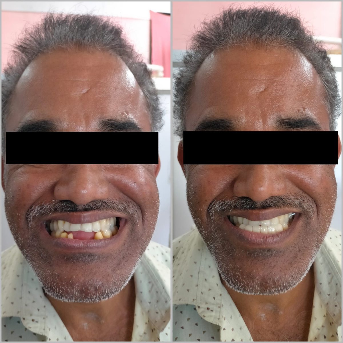 Dental Bridgework Treatment — before and after, patient 11