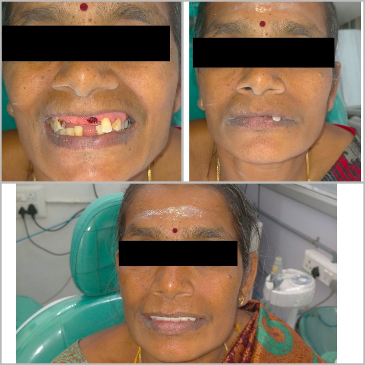 Dental Bridgework Treatment — before and after, patient 12