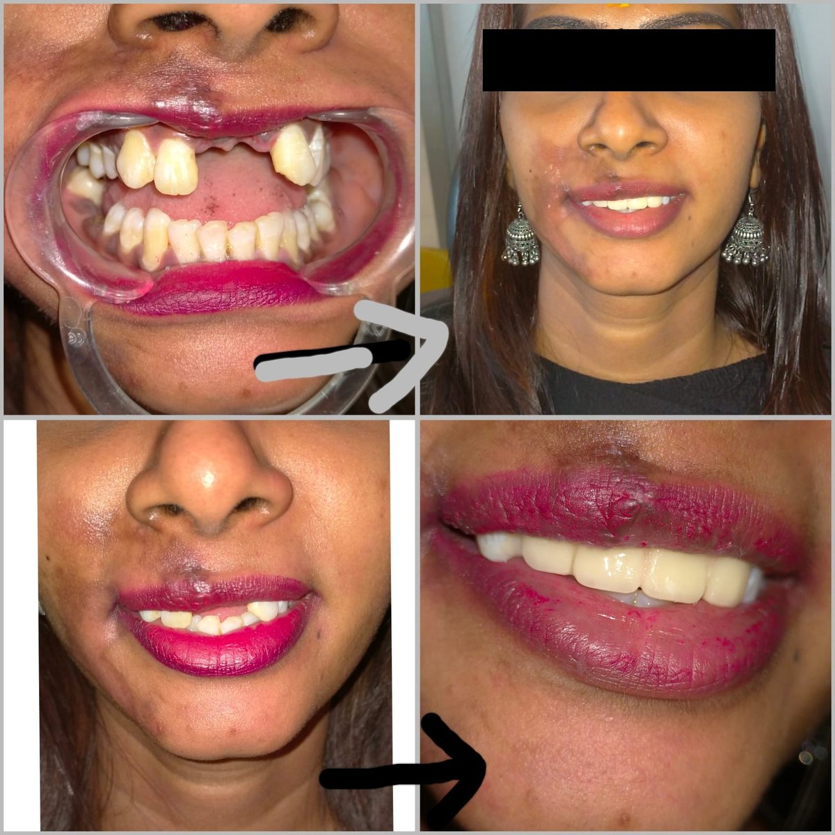 Dental Bridgework Treatment — before and after, patient 2