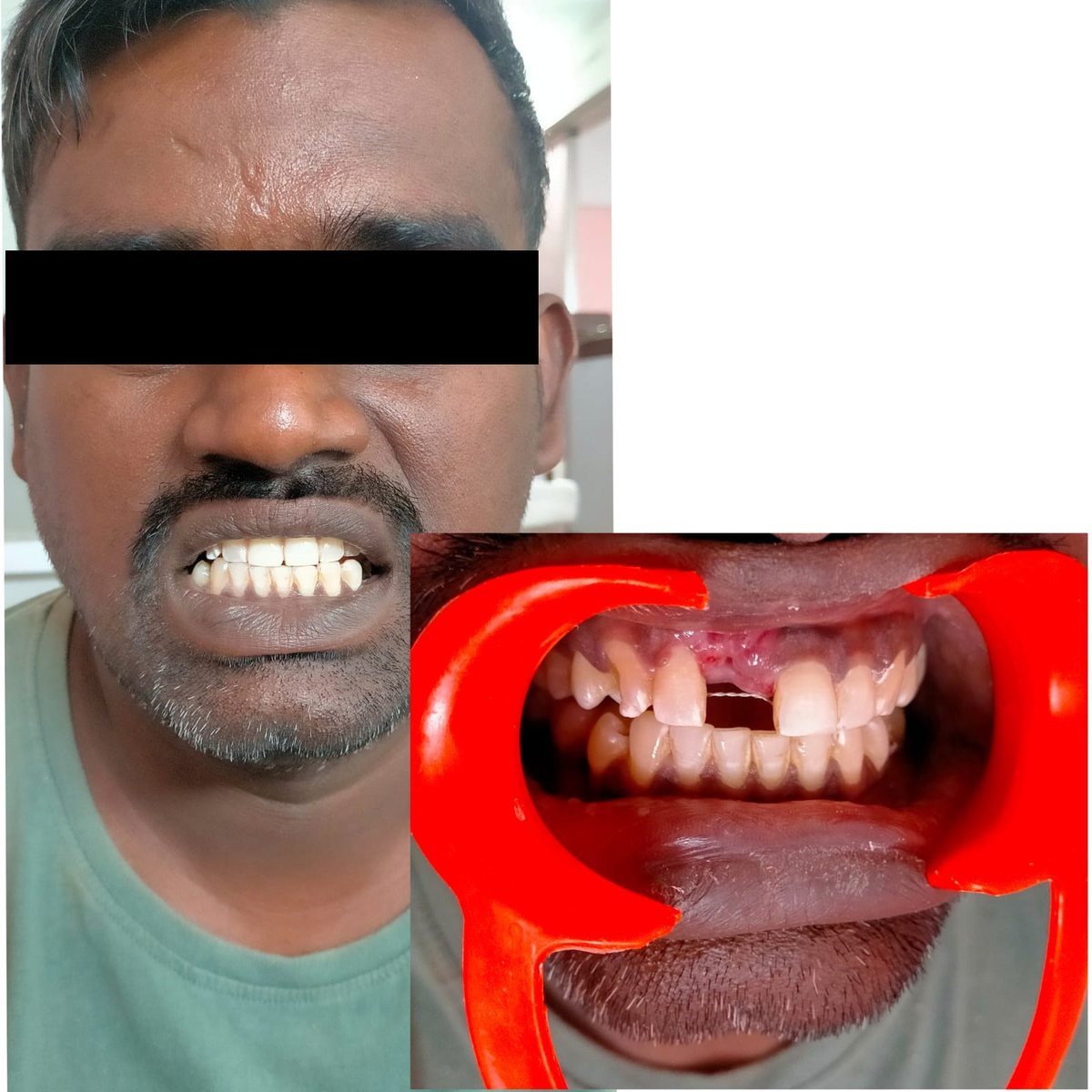Dental Bridgework Treatment — before and after, patient 3