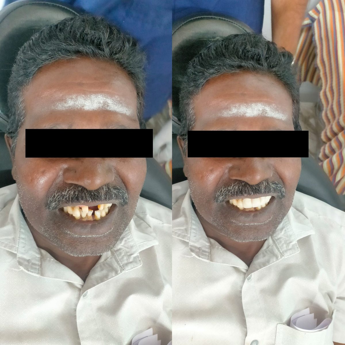 Dental Bridgework Treatment — before and after, patient 4