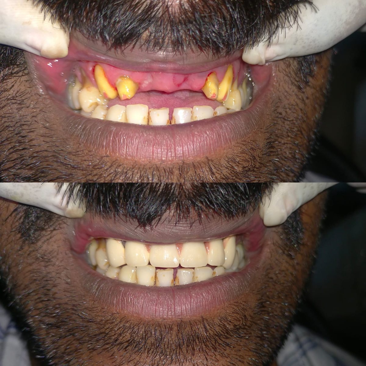 Dental Bridgework Treatment — before and after, patient 5