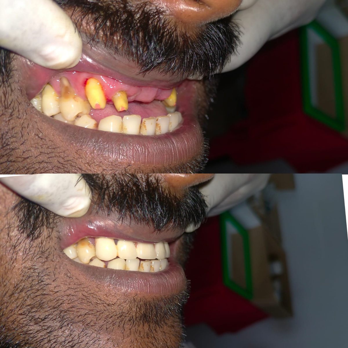 Dental Bridgework Treatment — before and after, patient 6