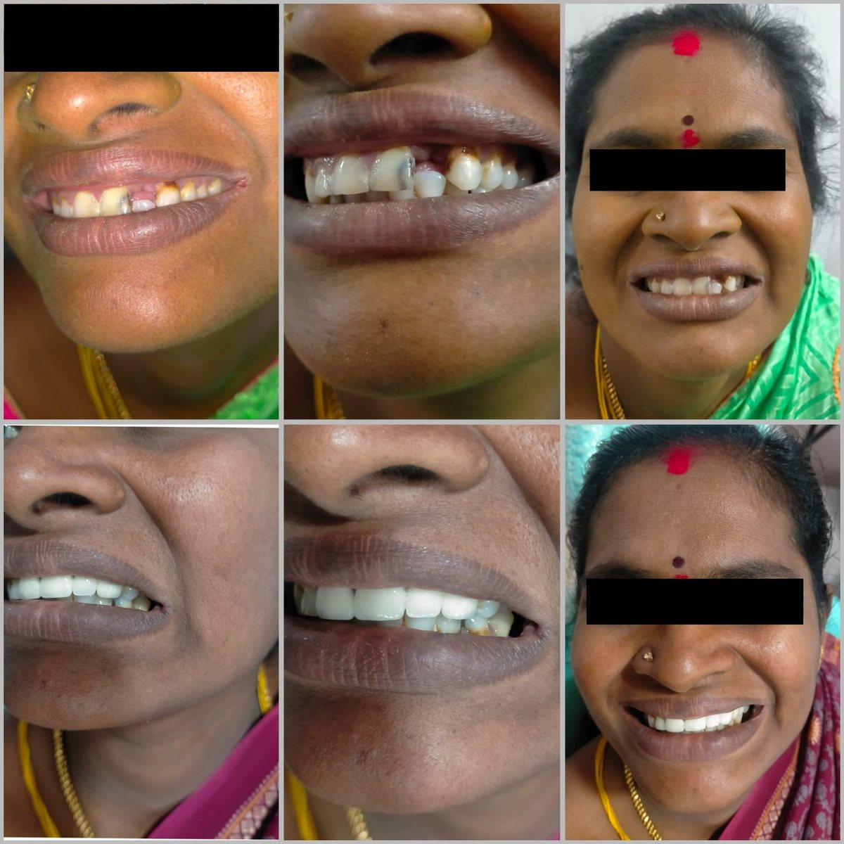Dental Bridgework Treatment — before and after, patient 7