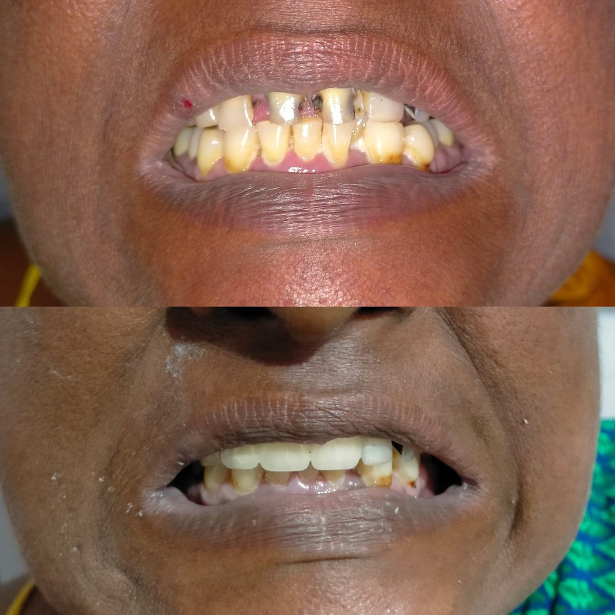 Dental Bridgework Treatment — before and after, patient 8