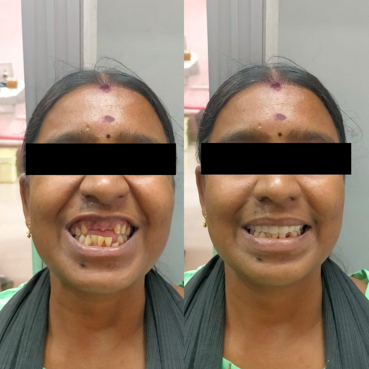 Dental Bridgework Treatment — before and after, patient 9