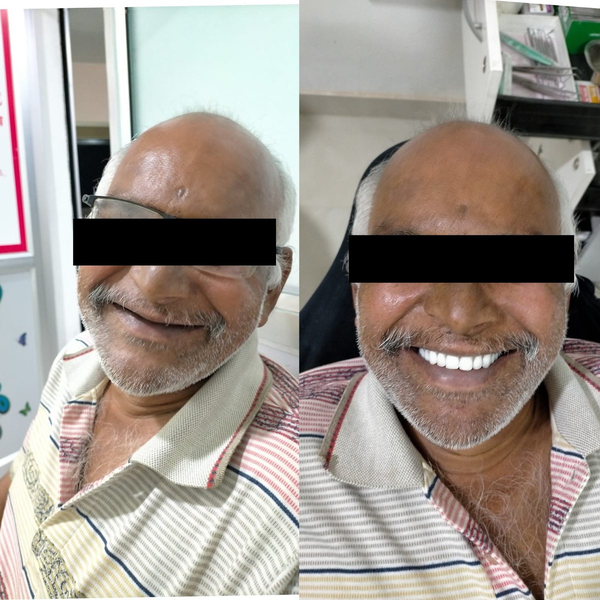 Denture Treatment — before and after, patient 1