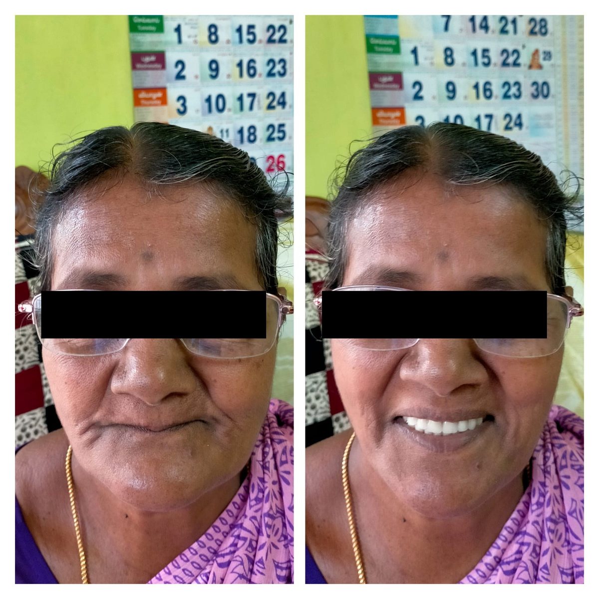 Denture Treatment — before and after, patient 2