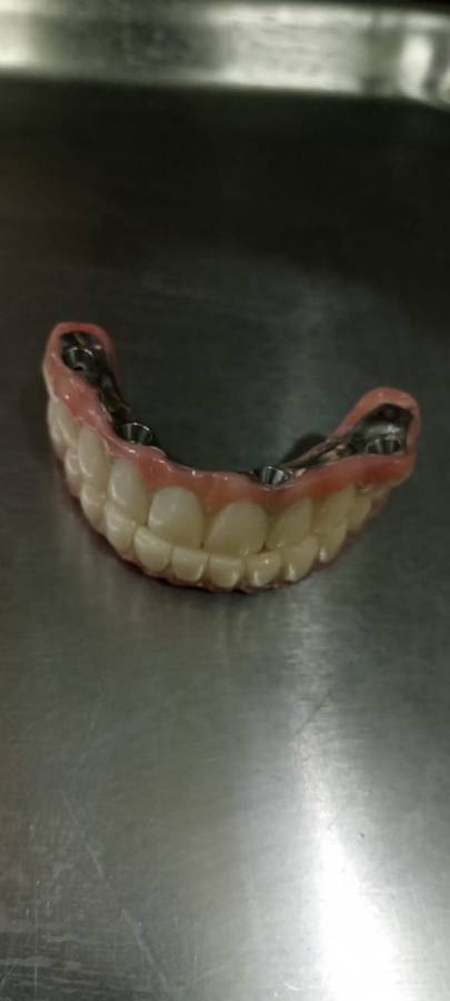 Implant — case photo 1