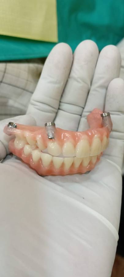 Implant — case photo 2
