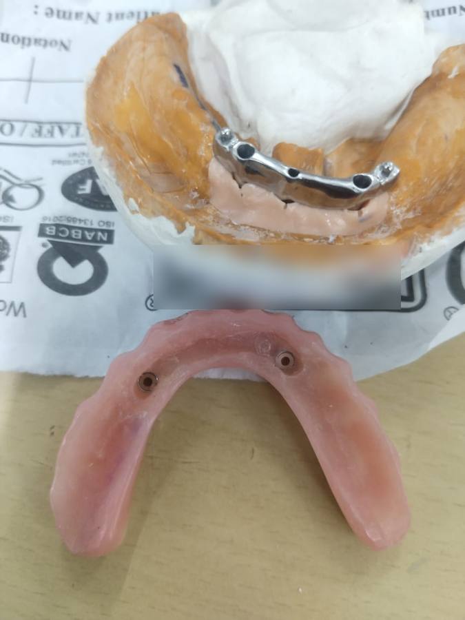 Implant — case photo 3