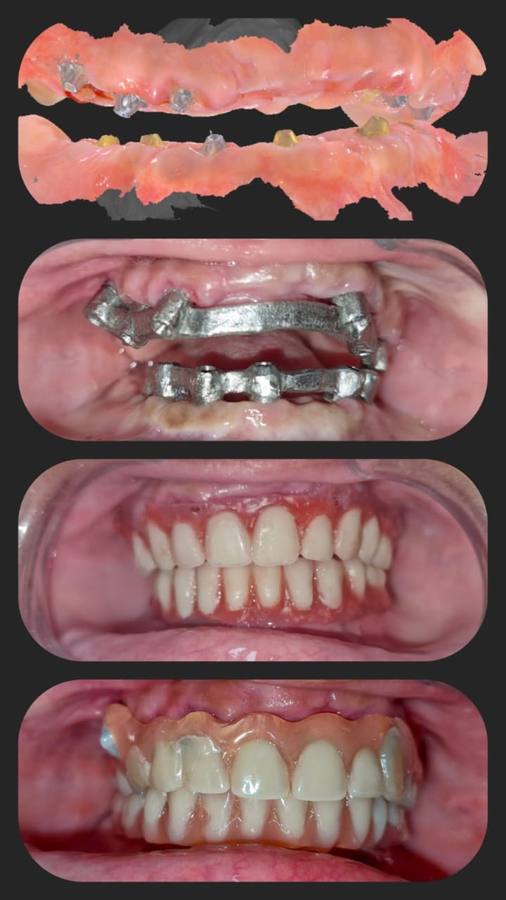 Implant — case photo 4