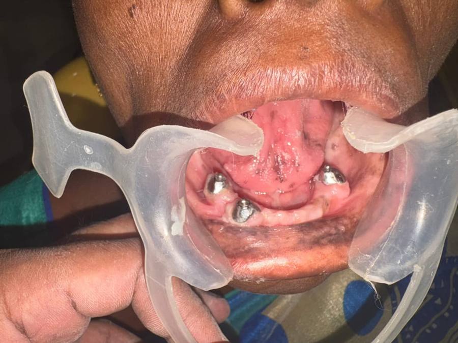 Implant — case photo 5