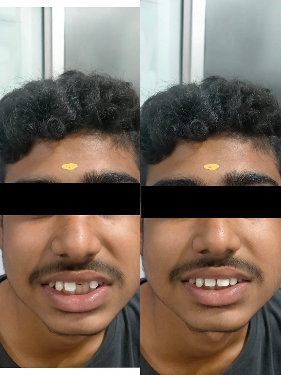 Other Tooth Fillings — before and after, patient 1