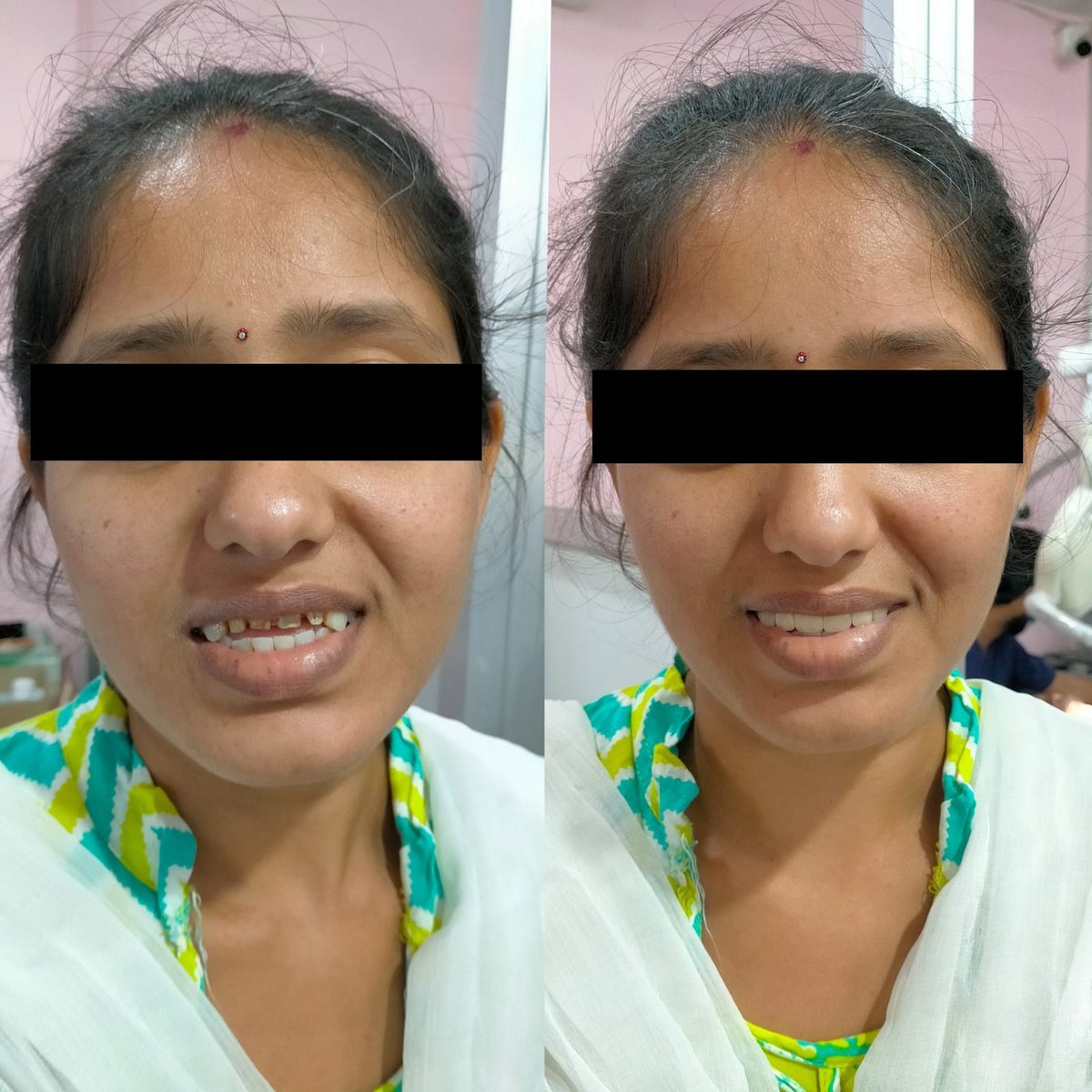 Smile Makeover Treatment — before and after, patient 1