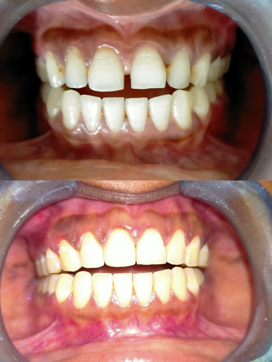 Smile Makeover Treatment — before and after, patient 10