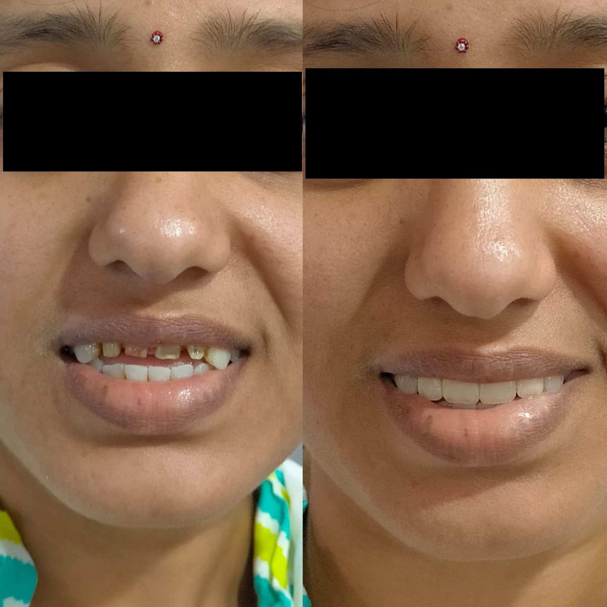 Smile Makeover Treatment — before and after, patient 2