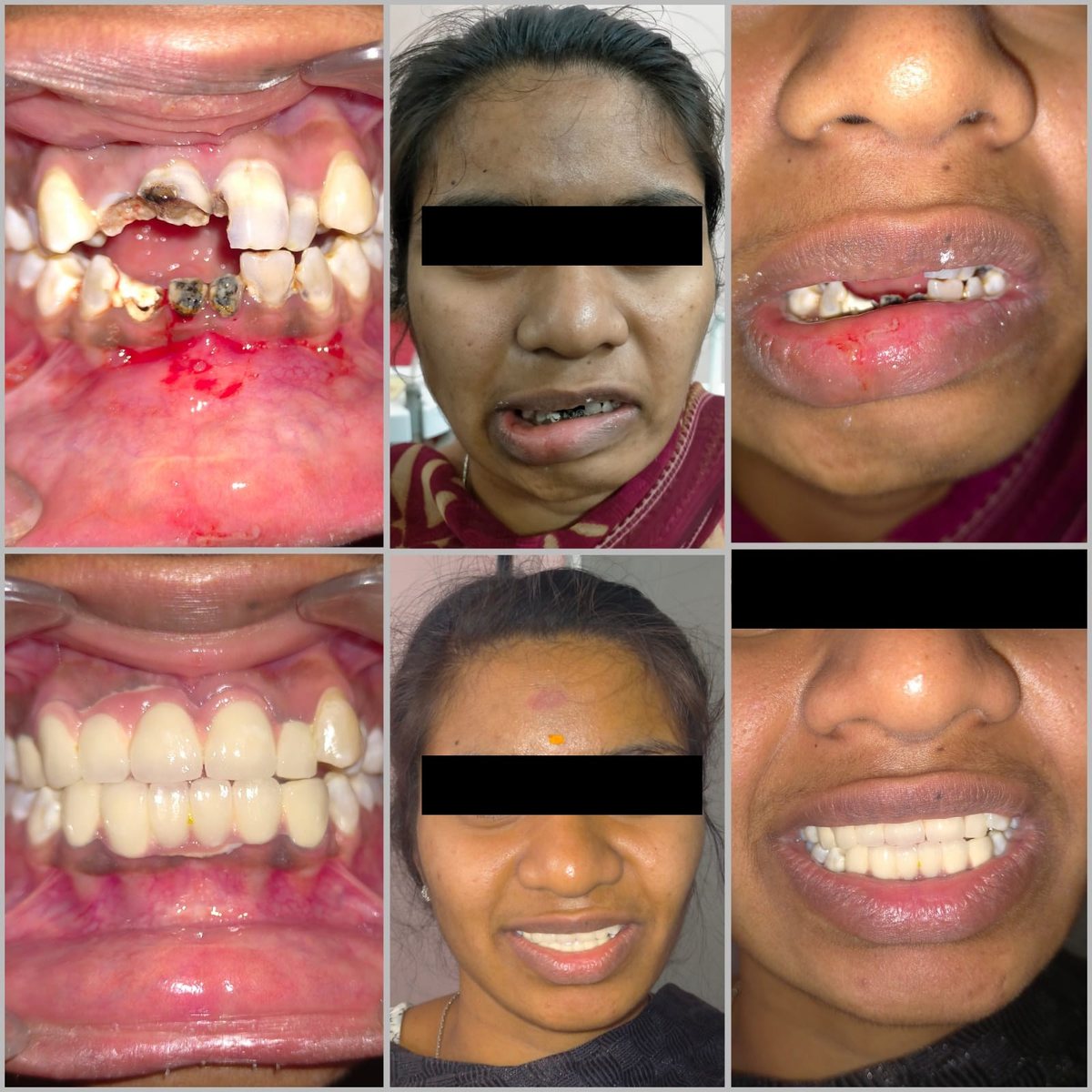 Smile Makeover Treatment — before and after, patient 3