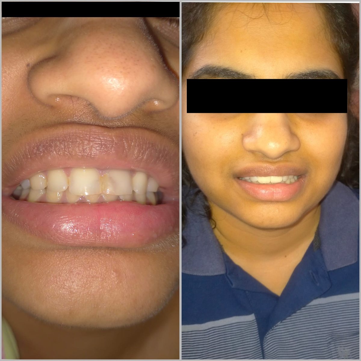 Smile Makeover Treatment — before and after, patient 4